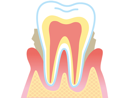 歯周炎