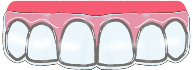 マウスピース矯正