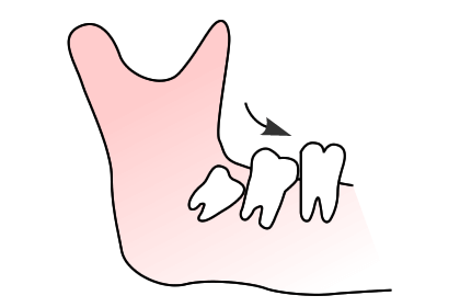 歯並びへの影響
